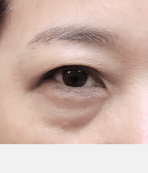 불룩한 눈밑 지방