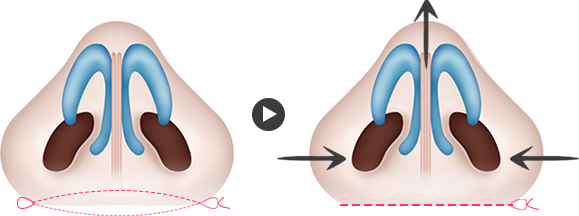 콧볼에 살이 많거나 콧구멍이 크지 않아도 콧구멍 아래쪽이 넓어 콧볼이 넓어 보이는 경우에는 콧구멍 아래쪽에 미세절개를 통해 실로 콧볼을 당겨 모아줍니다.