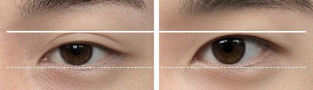 수술전 : 눈동자 노출량 60%, 수술후 : 눈동자 노출량 85~90%